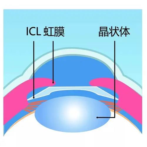 吴倩因ICL不良反应退赛？ICL晶体植入有什么后遗症？术后应注意什么？