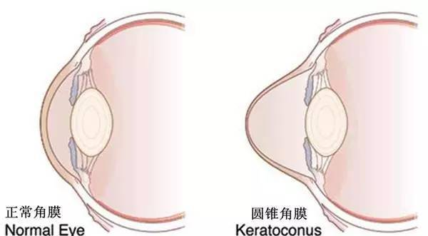 短期内视力急剧下降，需警惕圆锥角膜！