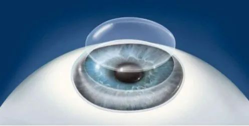 短期内视力急剧下降，需警惕圆锥角膜！