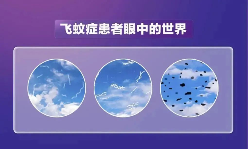 “飞蚊症”是老年人专属？不，高度近视的年轻人也要注意！