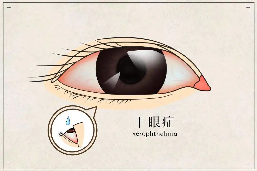秋风瑟瑟，眼睛干涩怎么办？——秋季护眼攻略大揭秘！
