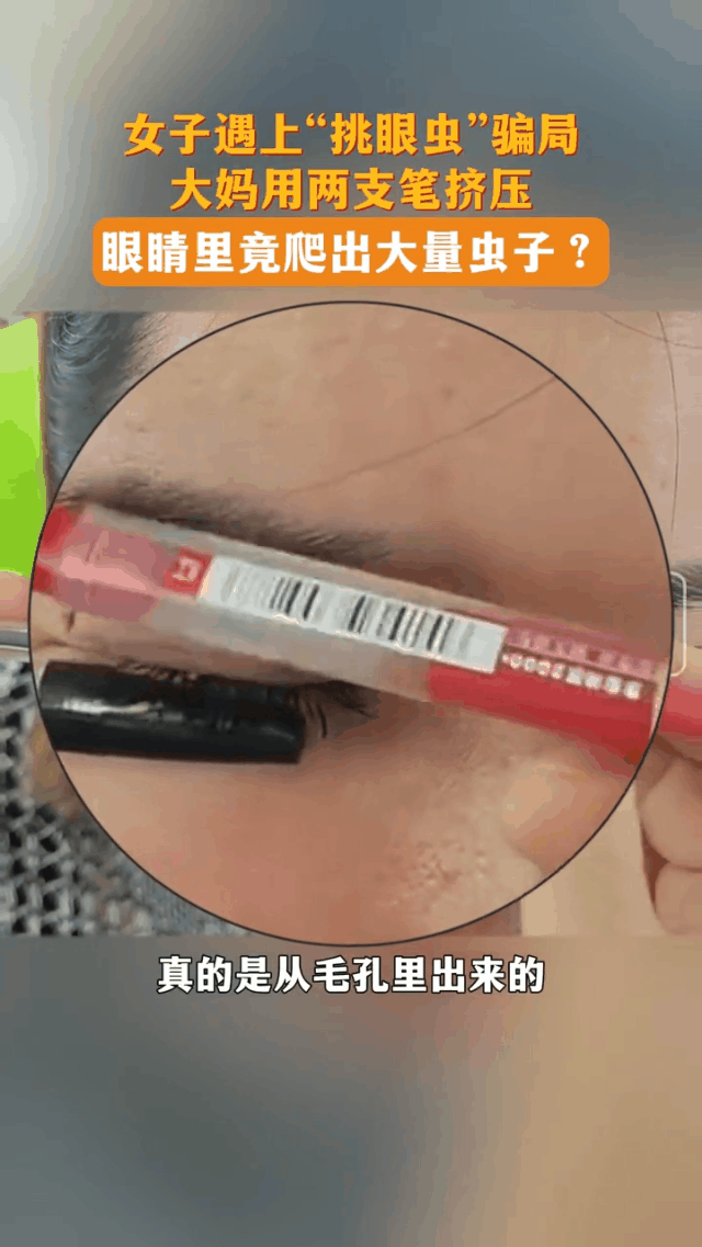 眼内挑出大量虫子是真还是假？睑板腺可以按摩吗？