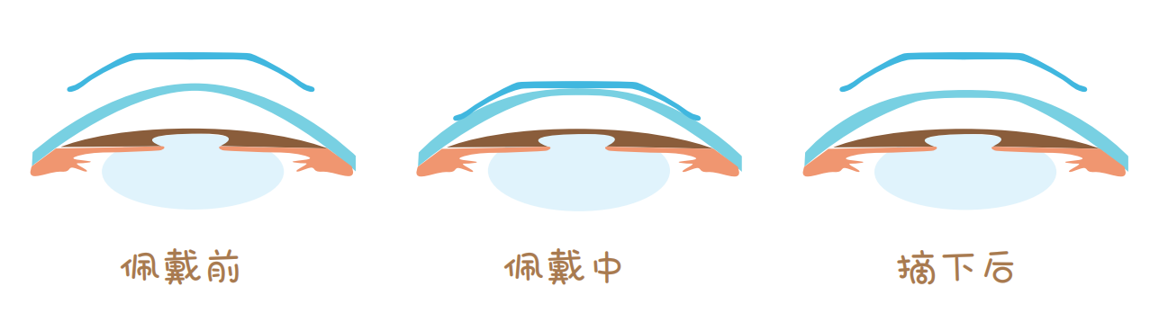 OK镜是什么，多少钱一副？