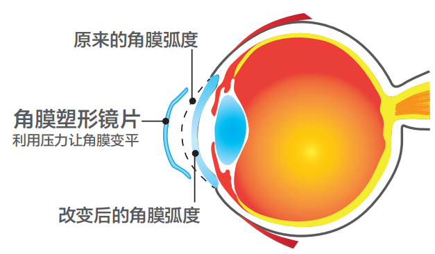 OK镜和离焦镜哪个防控效果好？