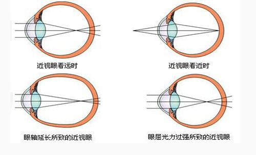 孩子近视防控新视角：除了眼轴，泪液渗透压是隐藏警报