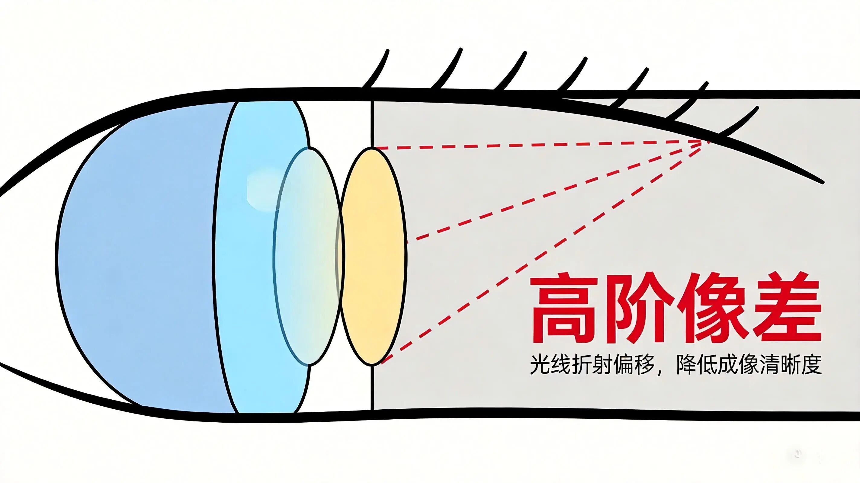 同样的300度,为什么她看1.0,你只能看0.6?配镜单上不会写的5个秘密! 同样的300度,为什么她看1.0,你只能看0.6?配镜单上不会写的5个秘密!