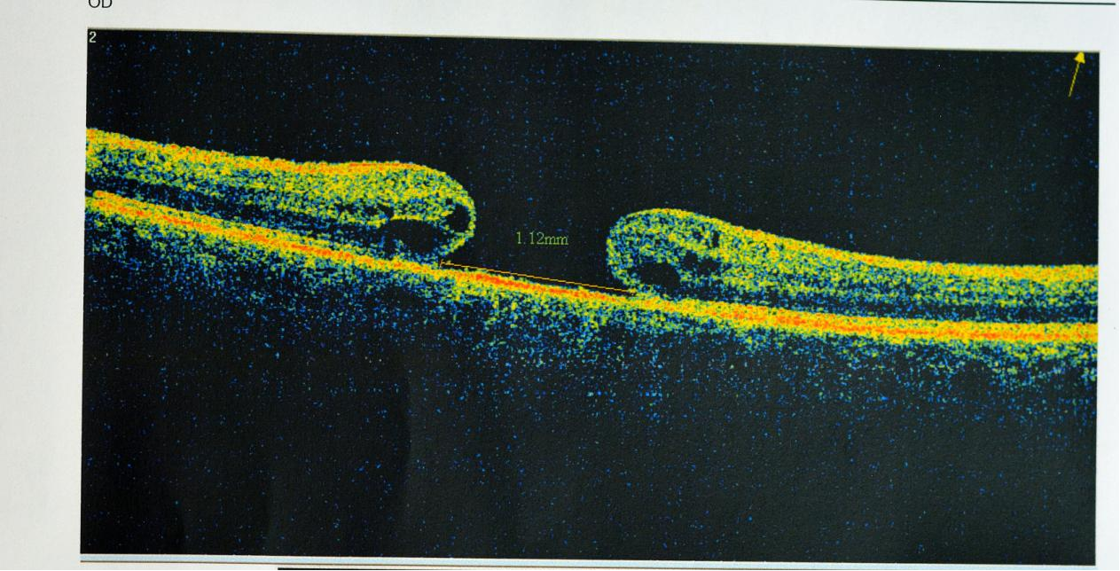 医生总让你做OCT，到底在查什么？一文读懂“眼睛断层扫描”的秘密！