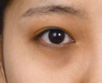 是体虚吗，要睡多久，才能把黑眼圈睡没？